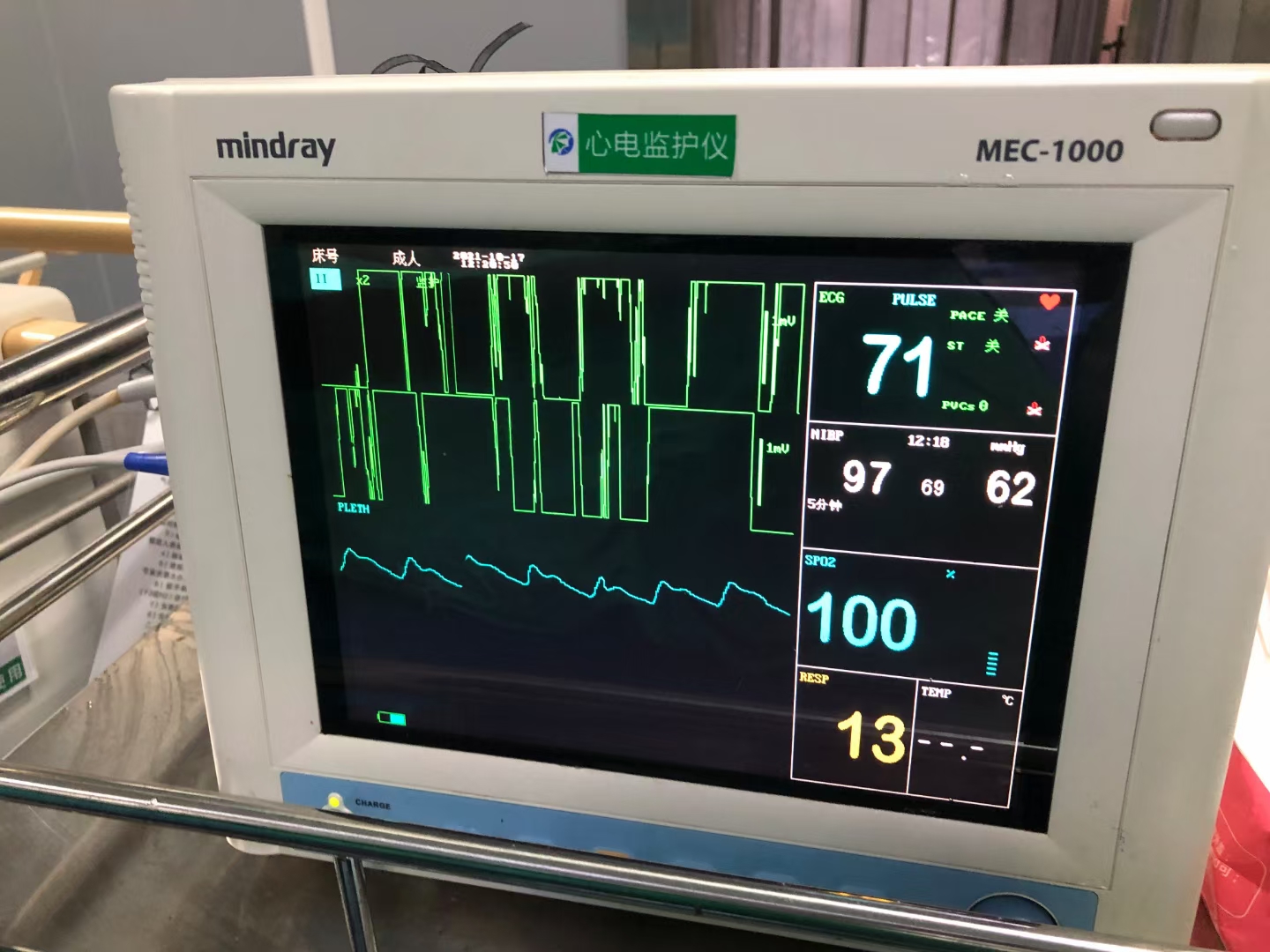 舌癌病例分享,舌癌吐血