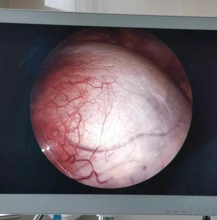 卵巢囊肿微创手术后患者状况,腹腔镜下卵巢囊肿切除术步骤