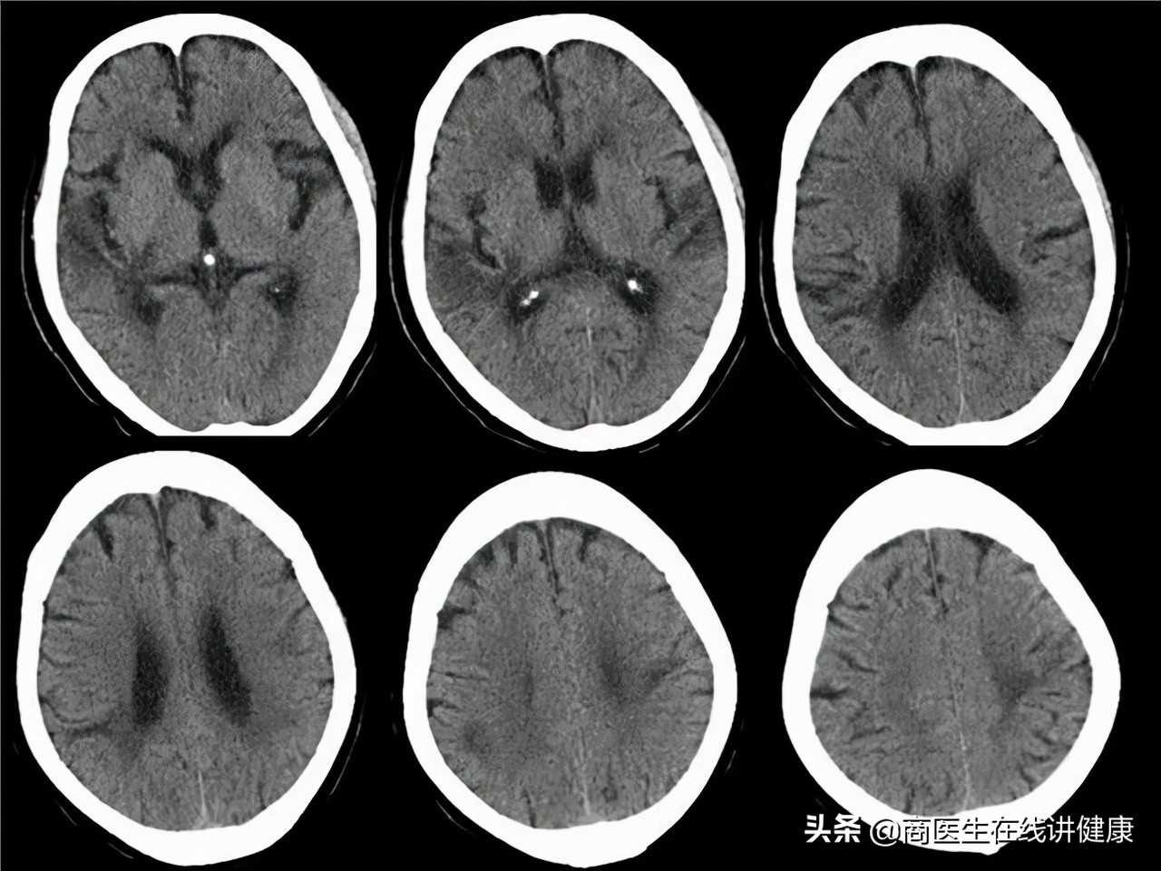 糖尿病人用甲钴胺好还是用b12好,糖尿病神经病变吃甲钴胺还是b12