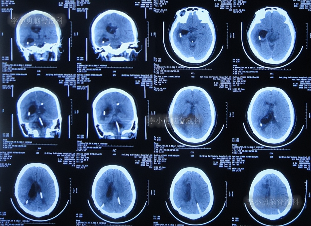 脑积水三脑室造瘘多久能恢复,脑囊虫手术后脑积水