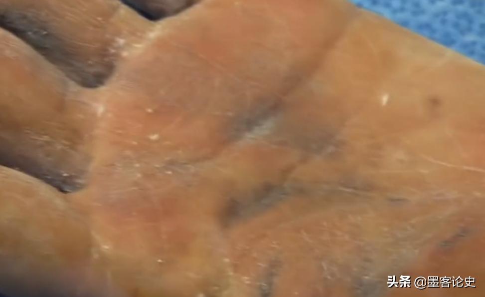 韩国大妈一生从不出汗,65度高温桑拿后仍然干燥,她的身体怎么了?