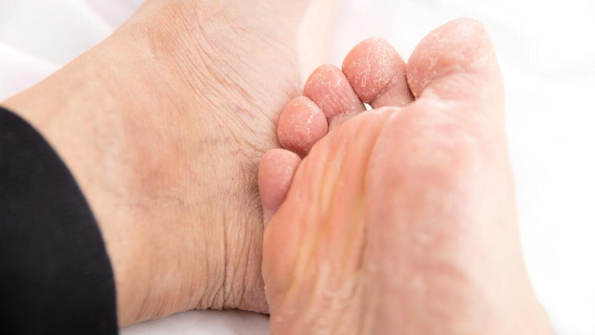 脚气很痒越挠越舒服是脚气吗,脚气越抹药膏越痒怎么回事