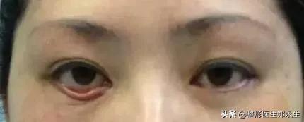 眼袋手术失败再次修复完交费吗,修复失败眼袋手术效果好吗