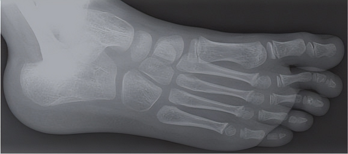 拇外翻几岁可以做手术,轻微拇外翻不好看可以手术吗