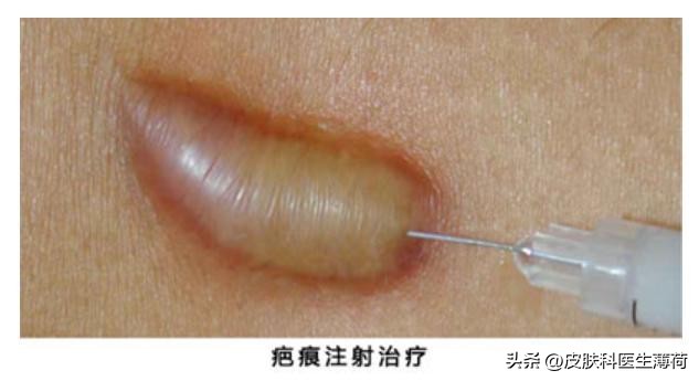 手术后留下的疤怎么消除,手术后疤痕很红怎么处理