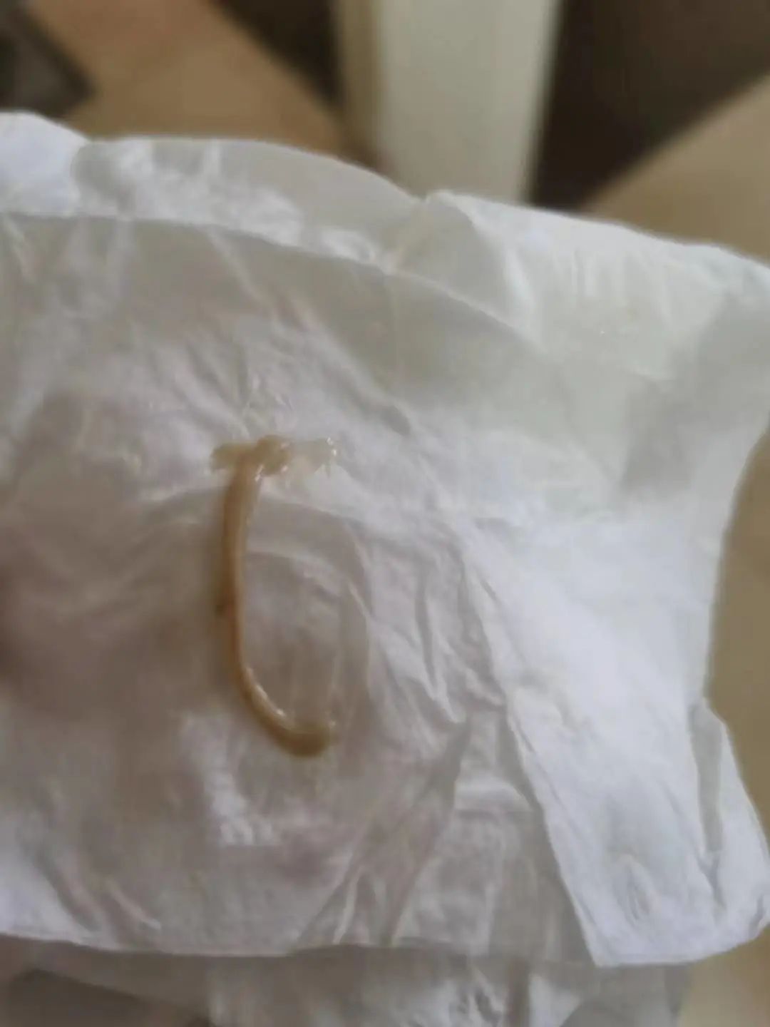 当哮喘患者咳出果冻样、啫喱样，甚至是长条形痰栓，究竟怎么了？