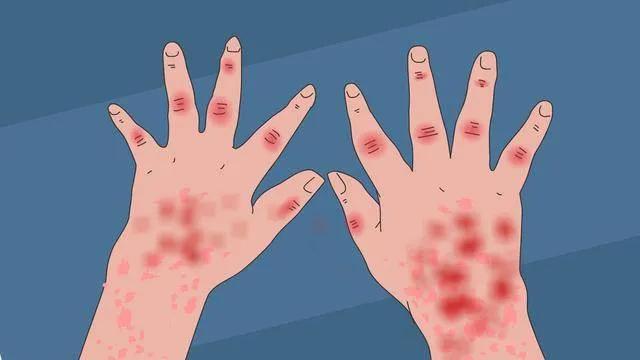 免疫性风湿性疾病好治吗,为什么风湿会复发