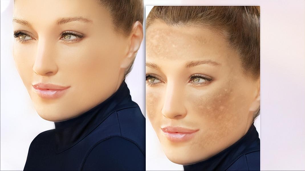 快速消除老年斑的小妙招红霉素,红霉素软膏对老年斑有治疗作用吗