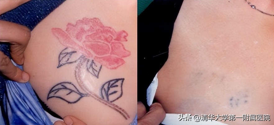 皮秒激光美白嫩肤祛斑紧肤,一起美起来