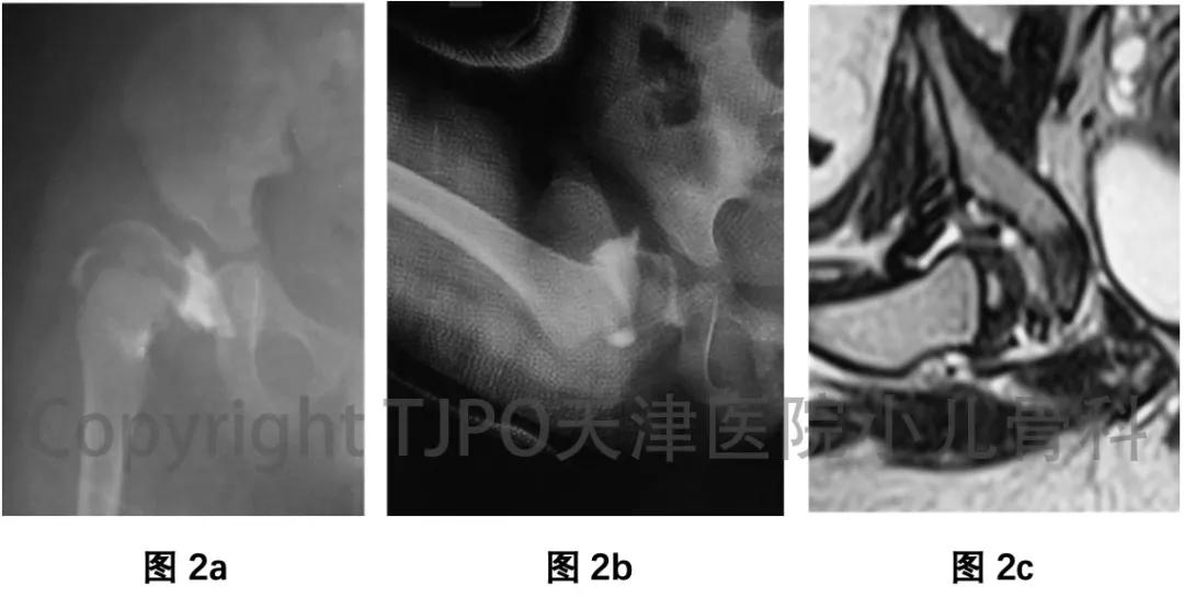 髋关节发育不良做完截骨术,髋关节发育不良截骨矫正能撑多久