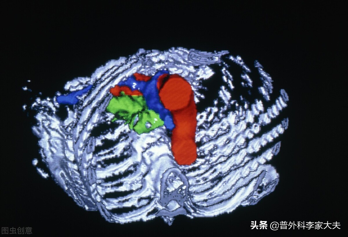 胰腺癌晚期腹水了生存期,胰腺癌晚期纳米刀生存期