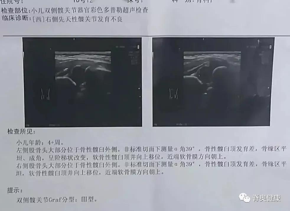 脊奥健康｜婴幼儿矫正案例—先天性髋关节发育不良+Tübingen支具