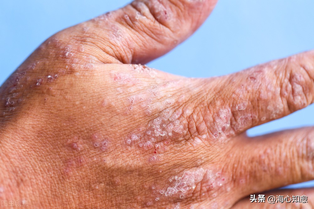 白蛋白紫杉醇常见副作用处理,紫杉醇白蛋白的副作用怎么缓解