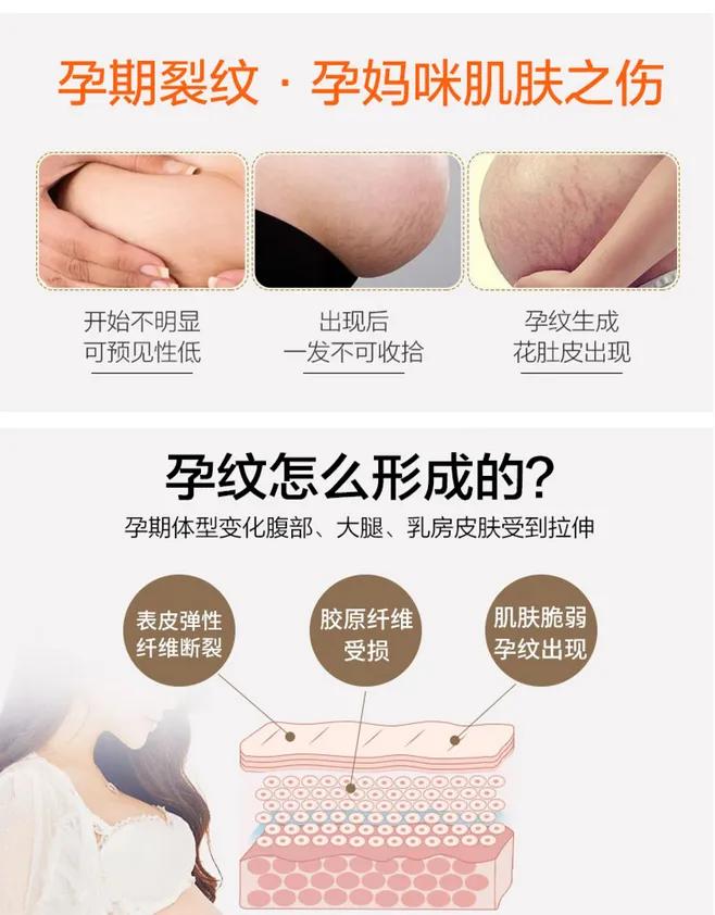 孕期长妊娠纹怎么消除,孕期长妊娠纹怎么办补救