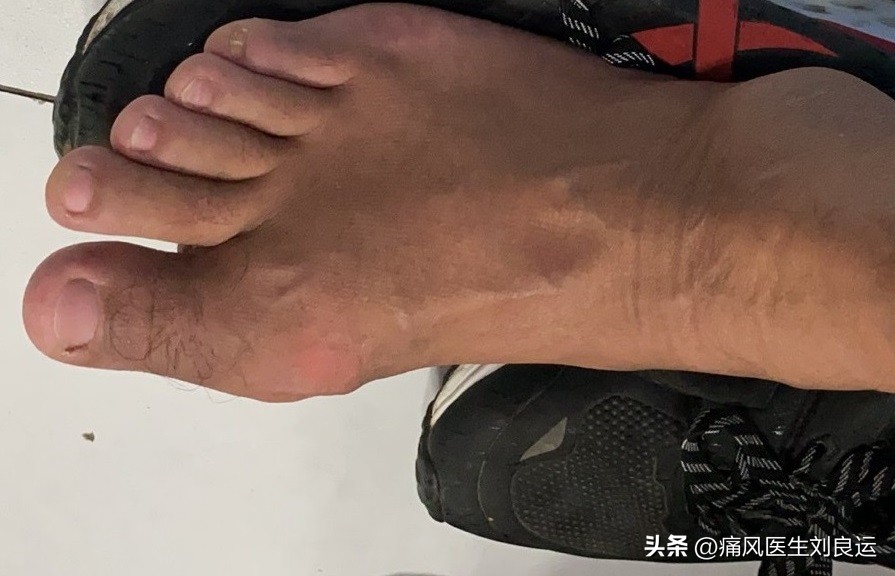 13岁小孩被查出痛风,13岁孩子痛风怎么治疗