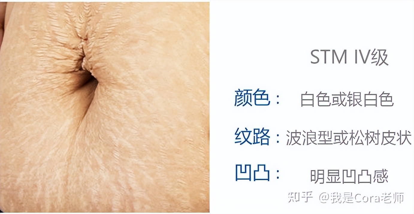 妊娠纹用什么方法可以修复,妊娠纹可以修复吗