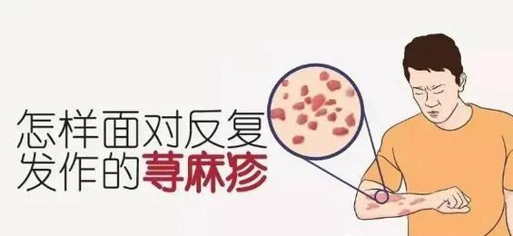 治疗急性荨麻疹的药哪些好,治疗急性荨麻疹有什么特效药吗