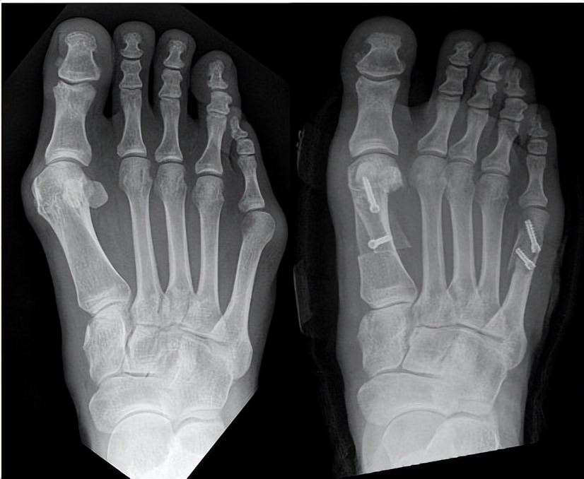 脚肥脚宽如何改善,脚肥怎么办教你一招