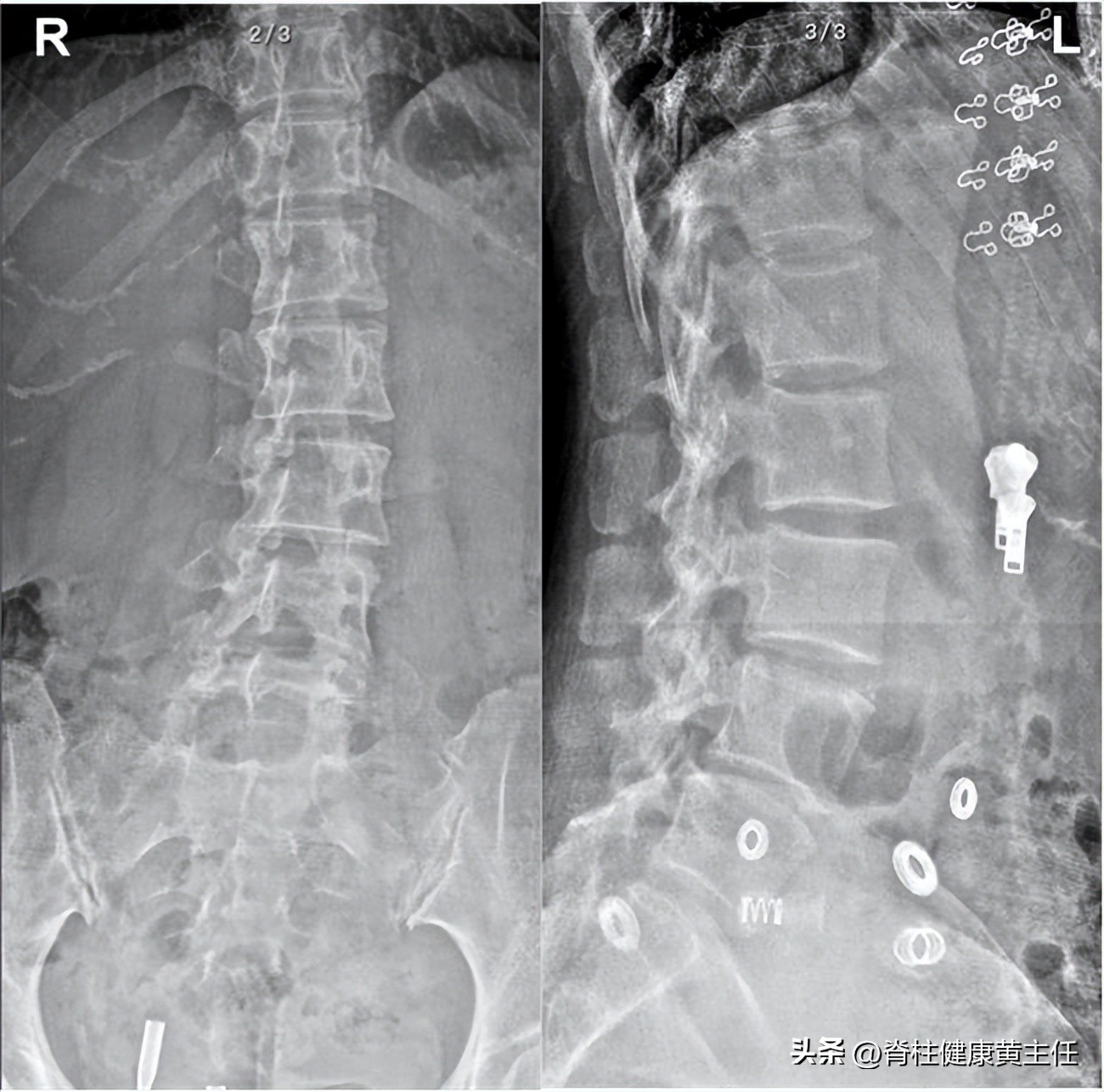 急性腰扭伤的原因症状及处理方法,急性腰扭伤原因症状及处理方法