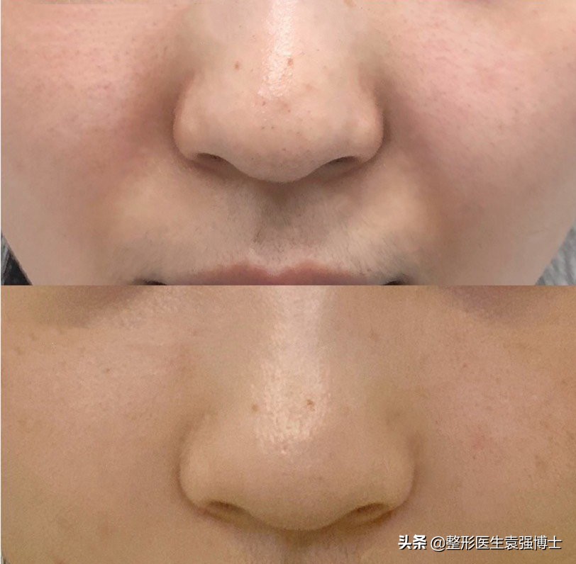 脸下垂有法令纹怎么办,经常耷拉的脸容易长法令纹