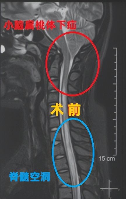 不是颈椎病颈肩痛怎么治疗,不是颈椎病肩膀脖子疼是怎么回事