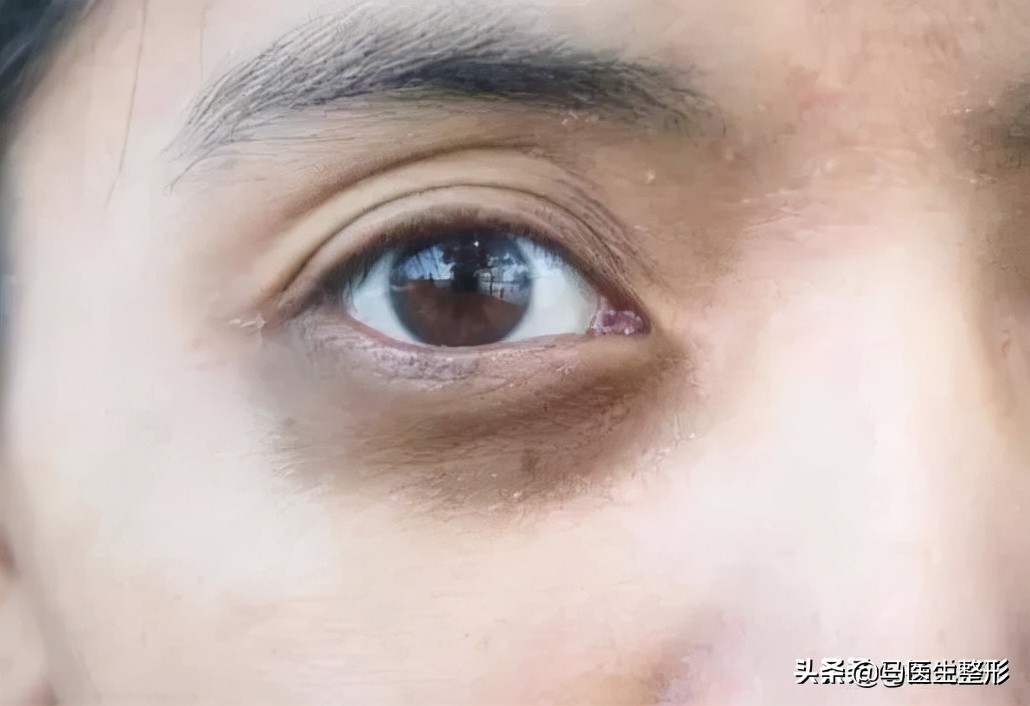 不熬夜黑眼圈还是去不掉是咋回事,很多年的黑眼圈了怎么才能淡化