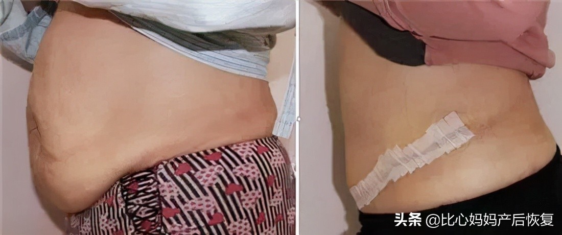 产后肚子大肚皮松怎么减肥,产后肚皮松垮皱巴巴怎么快速修复