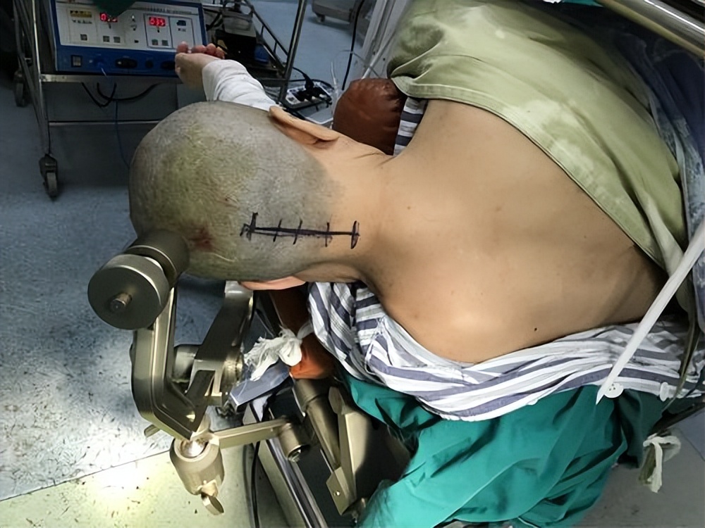 动脉瘤蛛网膜下腔出血术后并发症,动脉瘤导致蛛网膜下腔出血严重吗