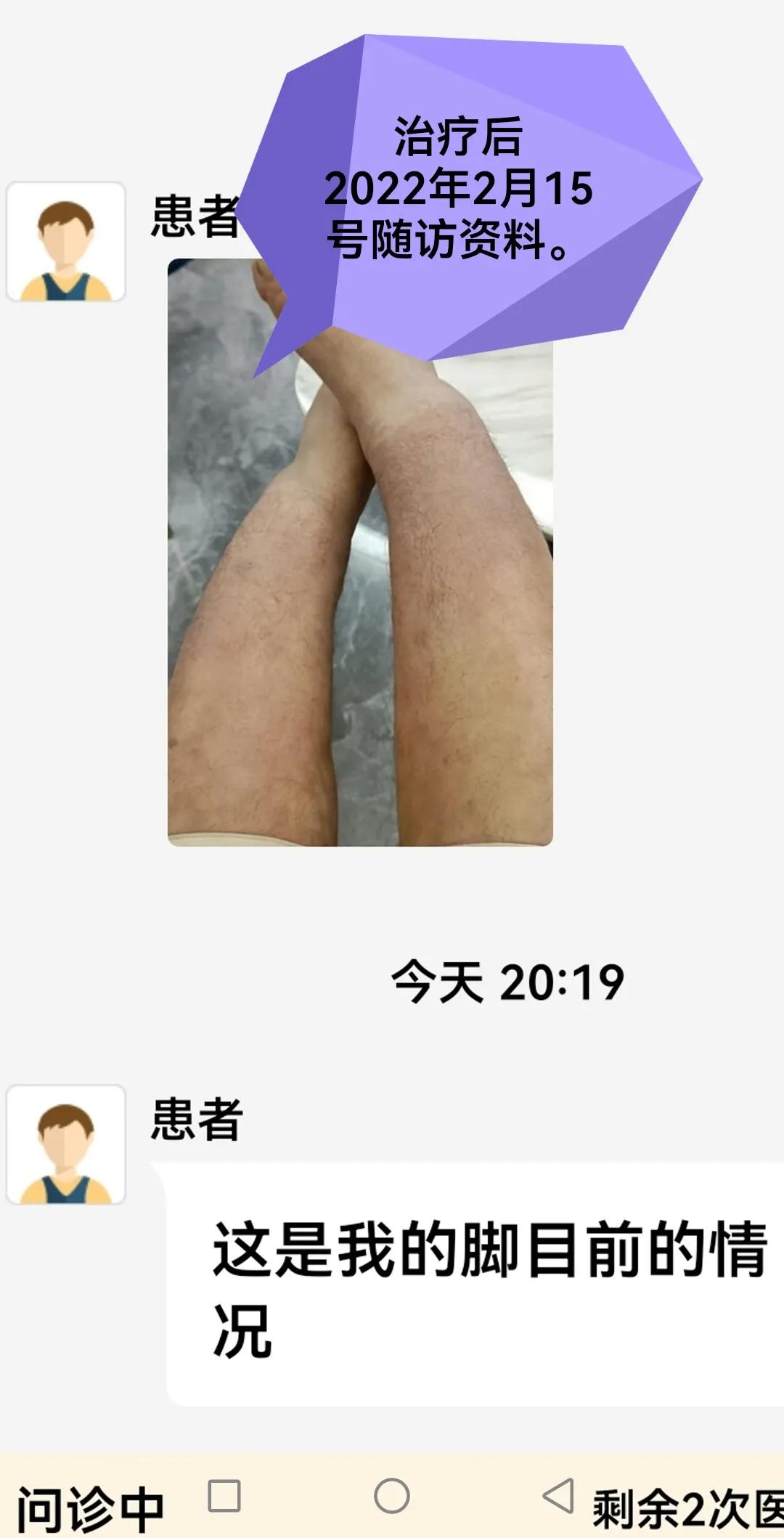 胫前骨粘液性水肿局部治疗,胫前粘液性水肿病例