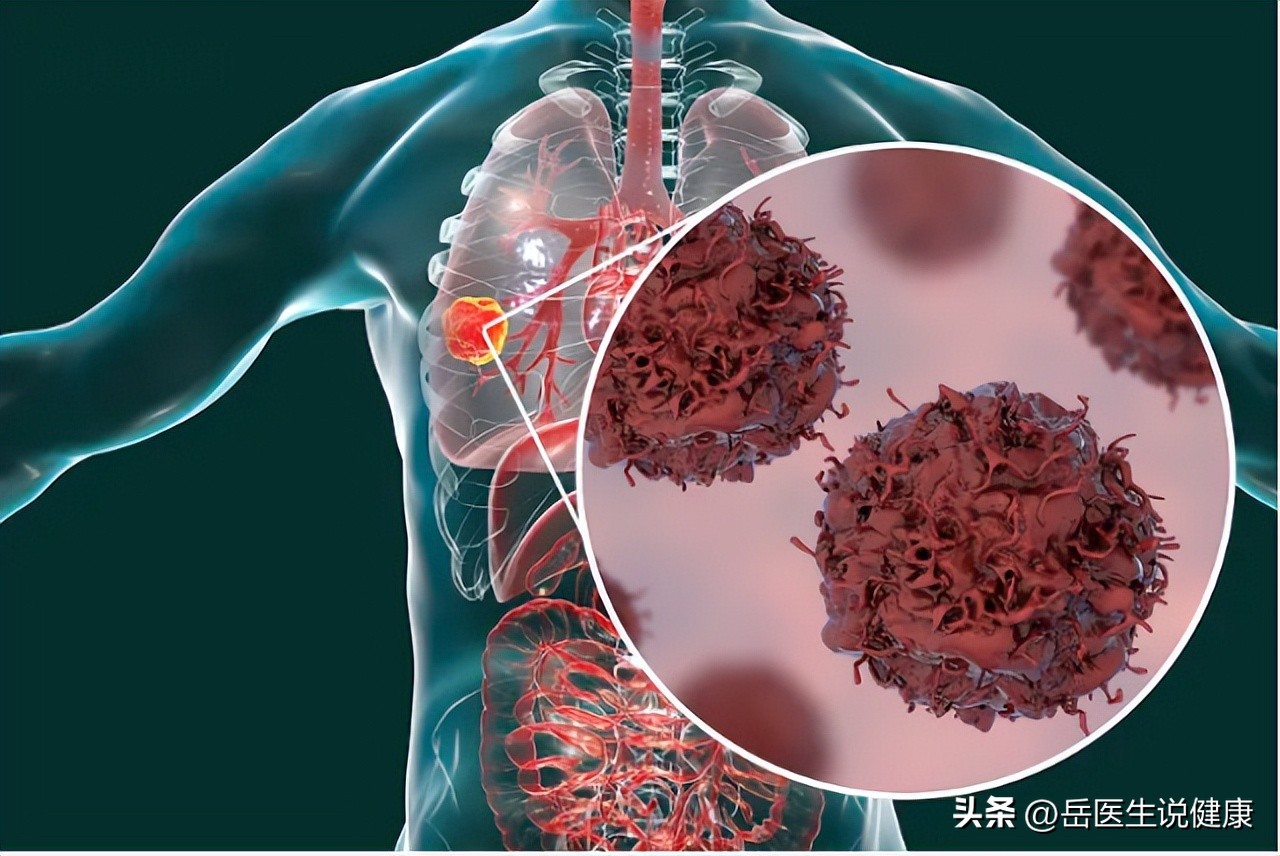 肺癌引起肩疼和一般肩疼区别,肩痛可能是肺癌早期
