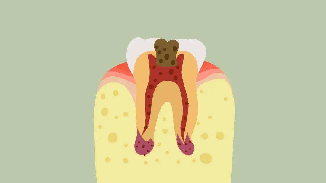 半夜出现牙疼和后背疼,牙出现大洞牙疼怎么办