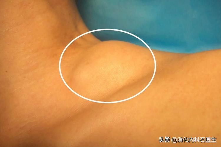 农民工头痛，按脑炎治疗无效，主任查房大怒：这个地方为啥没摸？