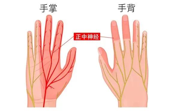 手痛、手麻？可能是腕隧道症候群
