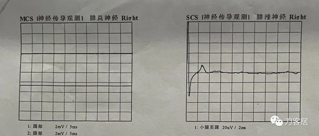 良性单侧下肢肌萎缩,下肢肌肉萎缩24年能治好吗