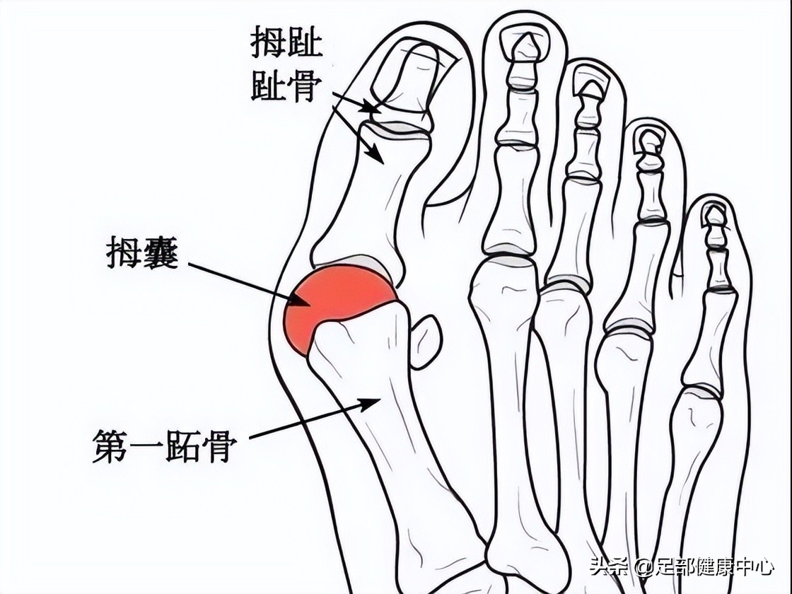 常见大拇趾疼痛原因,女性脚趾拇疼痛预示十种疾病