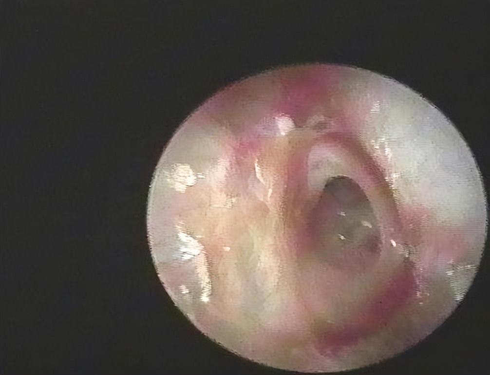 耳膜穿孔手术门诊可以做吗,潍坊鼓膜穿孔手术