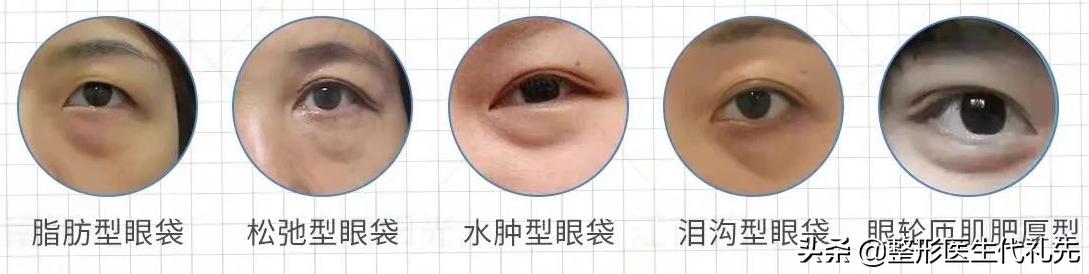 眼袋有皱纹是正常的吗,为什么眼睛下眼袋有点褶皱了