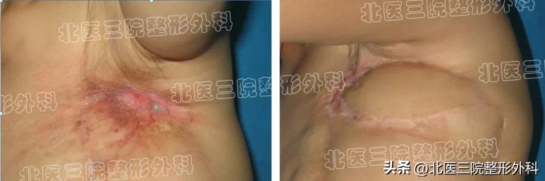 放疗皮肤溃烂里长白色疙瘩,放疗引起皮肤溃烂怎么处理