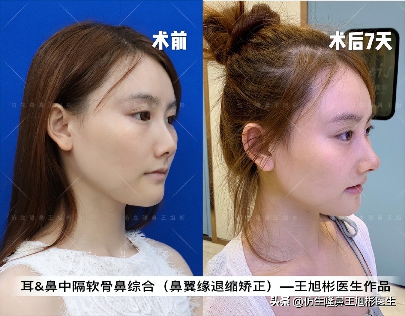 王旭彬：朝天鼻、露鼻孔，模特菲菲短鼻矫正手术后1.5个月