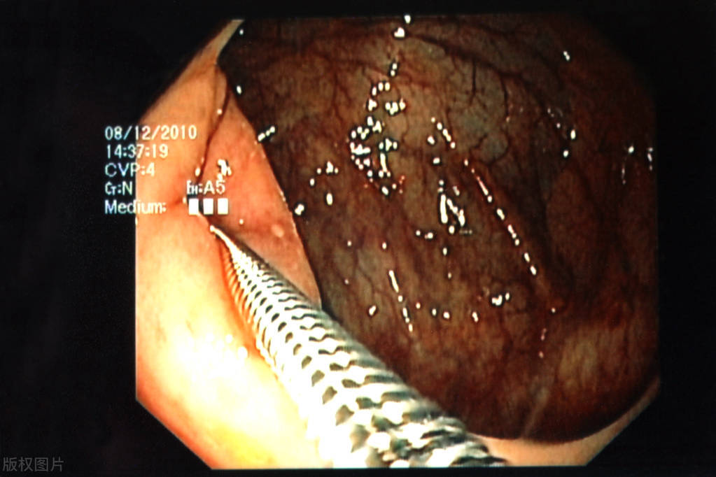 胃里面反酸烧心喝牛奶缓解,胃不舒服反酸怎么缓解