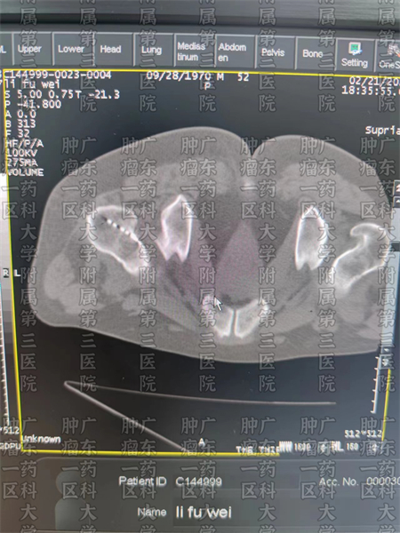 广州现代医院治疗肺癌骨转移,肺癌骨转移中医治疗成功案例视频