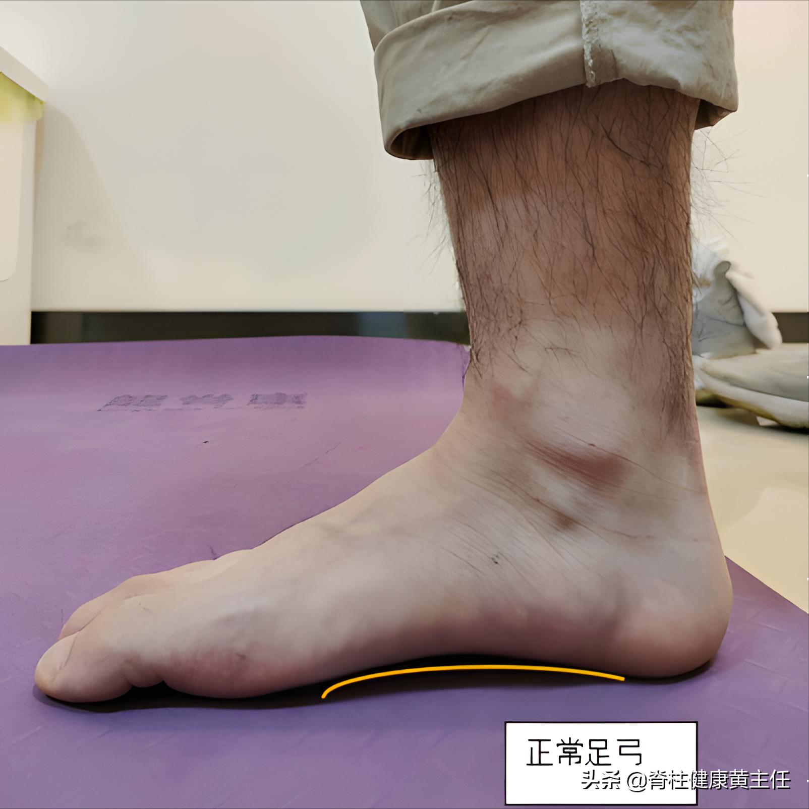 怎样判断自己有没有扁平足,怎么判断自己扁平足严不严重