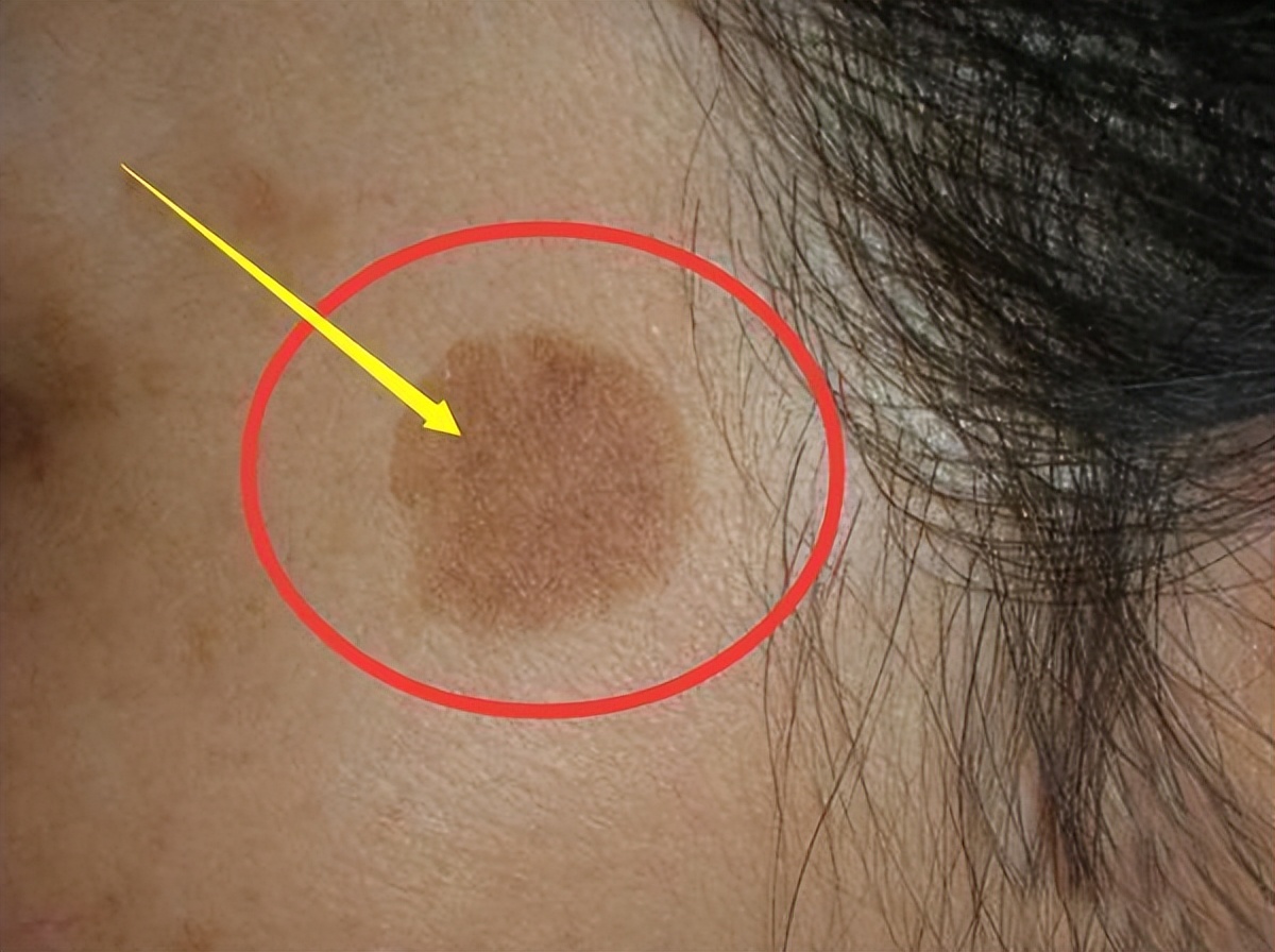 红霉素软膏可以去除老年斑么,红霉素软膏能够去除老人斑