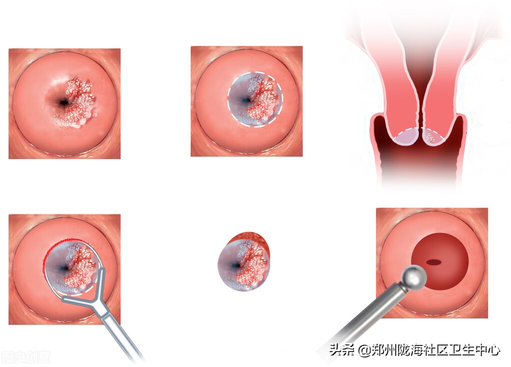 我的头上有青青草原,女友查出感染hpv