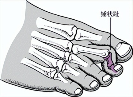 童鞋有毒事件,有毒的童鞋有哪些