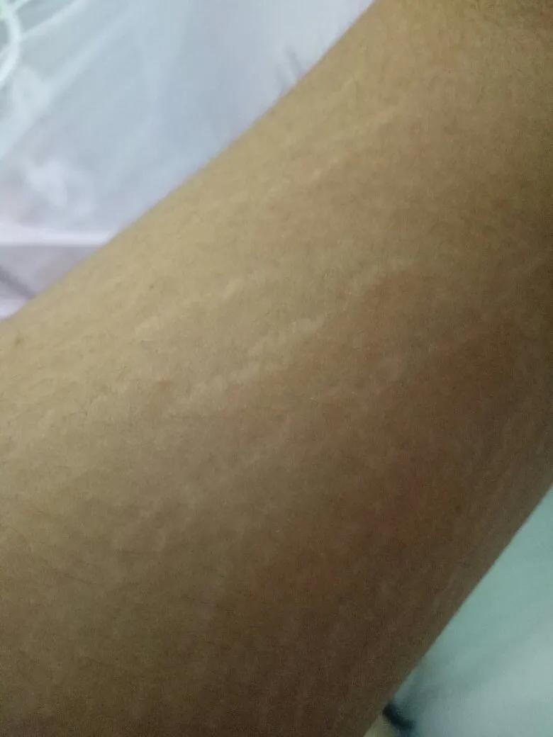 大腿上有白色条纹怎么回事,大腿两侧有白色条纹