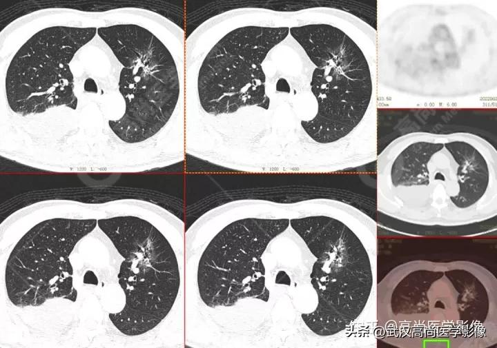 10毫米的肺结节恶性死亡率有多大,1厘米多的肺结节良性可能性多大