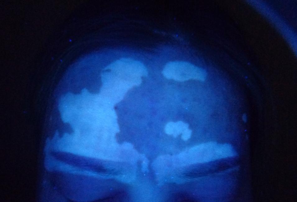 脸上的白癜风发展的太快好冶吗,面部白癜风恢复经历