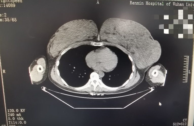 半年内*杯罩**从“C”到“G”：医生为巨乳症女子切除11斤乳腺组织