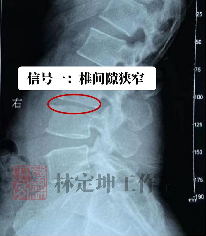 腰痛针灸和贴膏药哪个效果好,腰腿痛针灸最有效吗